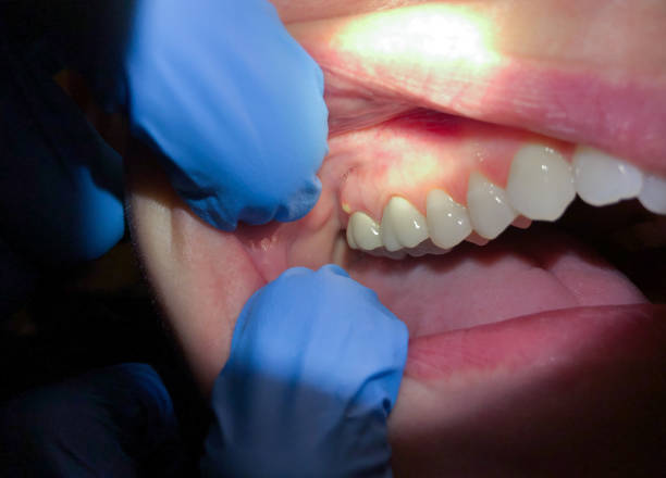 Best Emergency Root Canal Treatment in Middletown, MD